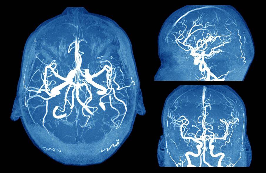 three views of a brain scan